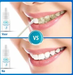 B-care Tanden Bleker – Wittere Tanden – Teeth Whitening Strips – Professioneel Resultaat - Tandsteen Verwijderaar - Zonder Peroxide - Tandenbleekset - Tanden Bleken -Mondverzorgings Winkel 1177x1200 3
