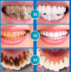 B-care Tanden Bleker – Wittere Tanden – Teeth Whitening Strips – Professioneel Resultaat - Tandsteen Verwijderaar - Zonder Peroxide - Tandenbleekset - Tanden Bleken -Mondverzorgings Winkel 1181x1200 5