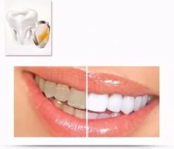 Merkloos Tanden Whitener Pen - Professionele Tandenbleek Gel - Tandenbleker -Mondverzorgings Winkel 1200x1026 1