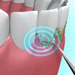 Toppers Van TV - Sonic Tandsteenverwijderaar - Tandplakverwijderaar -Mondverzorgings Winkel 1200x1200 1023