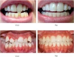 Edoir Rechte Tanden Beugel - Retainer Voor Rechte Tanden - Rechte Tanden Bitje -Mondverzorgings Winkel 1200x929