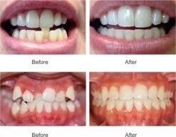 SAMA Direct™ Rechte Tanden Zonder Beugel - Orthodontische Bitjes - Rechte Tanden Bitje - Beugel - Knarsbitje - Nachtbeugel - Knarsen Bitje - Rechte Tanden - Witte Tanden -Mondverzorgings Winkel 1200x938 2